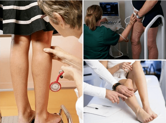 Varicose veins on the legs
