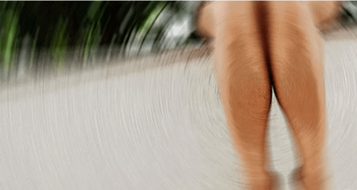 how to treat varicose veins at home