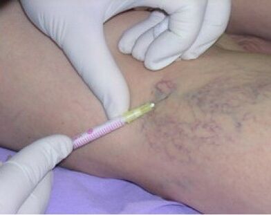 injections for varicose veins