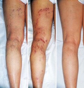 The result of treatment of varicose veins of the lower extremities