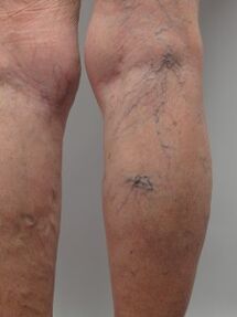 With varicose veins of the lower extremities, tortuous veins protrude above the surface of the skin